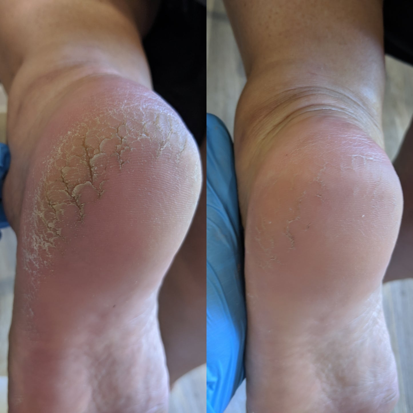 LOVASKIN DUO 500 ml - Plus de 125 soins anti-callosités